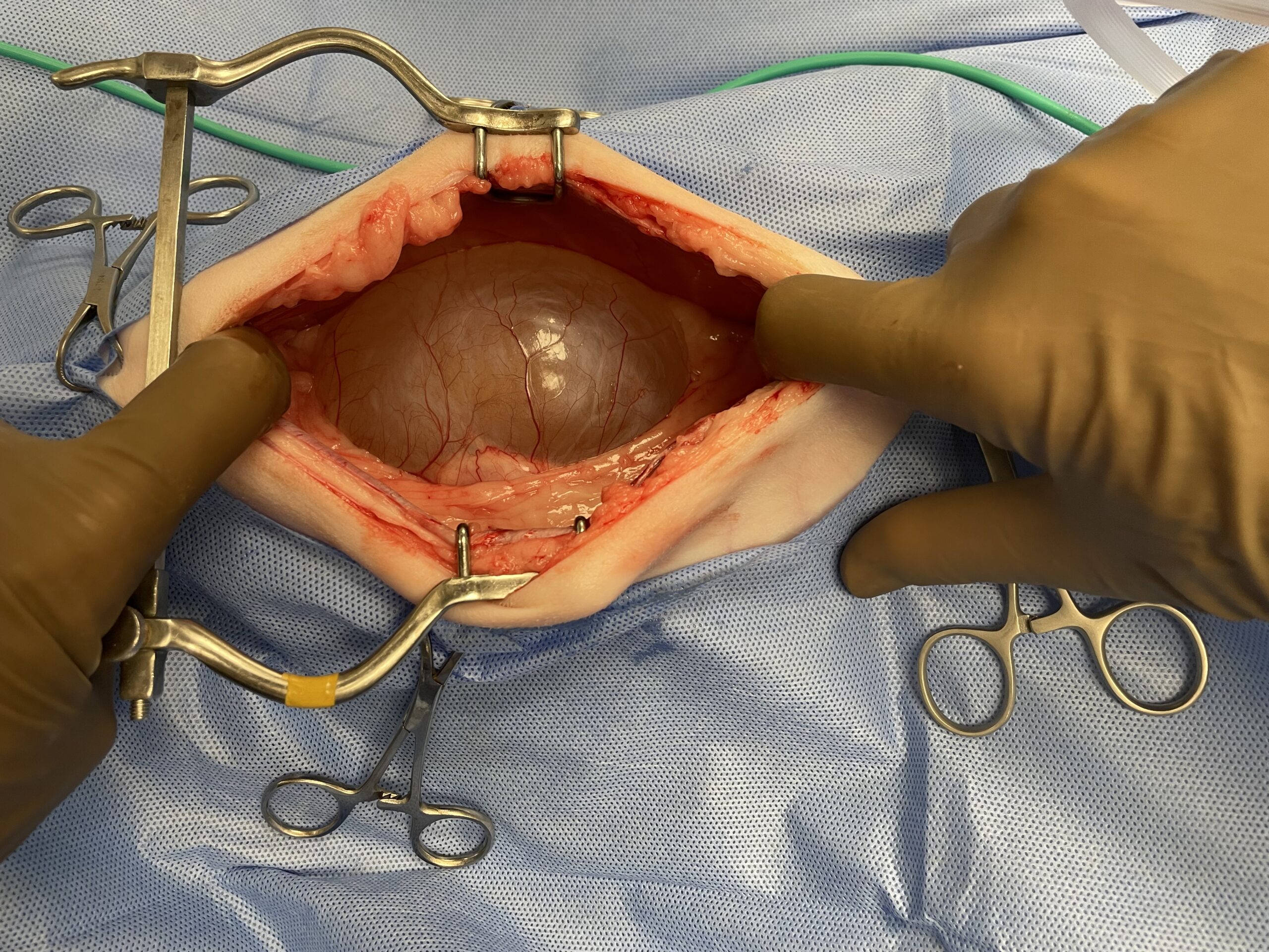 Taz intraop 1 Taz intraop 1